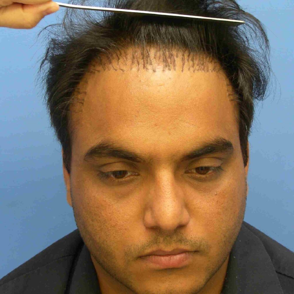 hair-plugs-before-1024x1024.jpg
